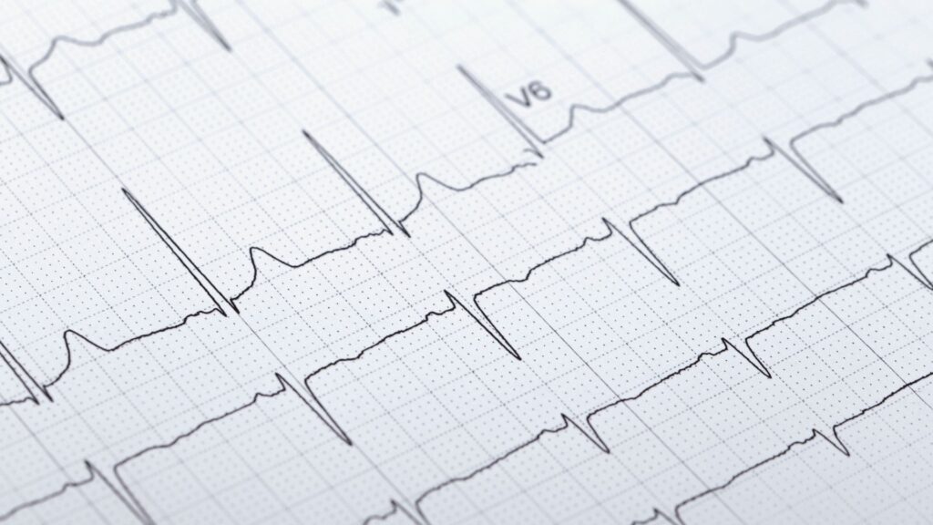 EKG Ausdruck - Grundlage für HRV-Messung und autonome Balance